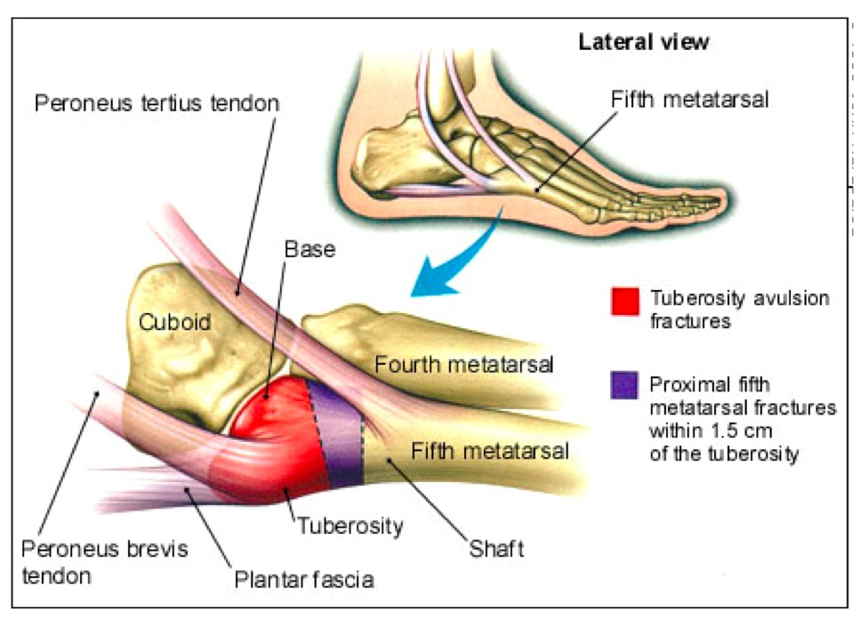 Figure 4 for case Fifth metatarsal base injuries